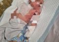 Rawat Jalan Disarankan Setelah IGD, Balita Sukolilo Mengidap Penyakit Kulit Langka