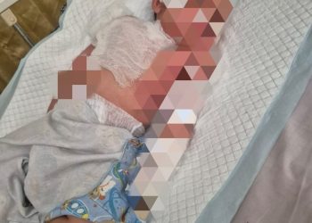 Rawat Jalan Disarankan Setelah IGD, Balita Sukolilo Mengidap Penyakit Kulit Langka